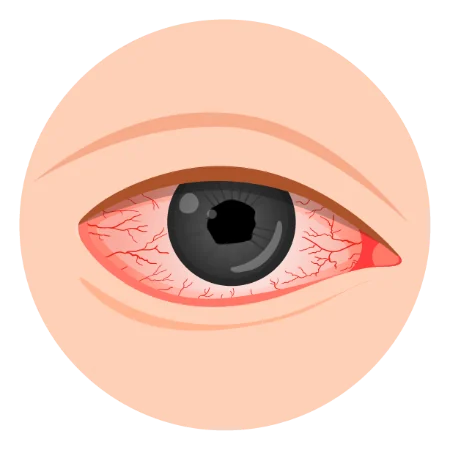 건조하고 충혈된 눈
